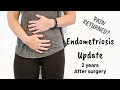 My Endometriosis Surgery and Recovery Story |How I Healed my Endometriosis - 2 years after Surgery