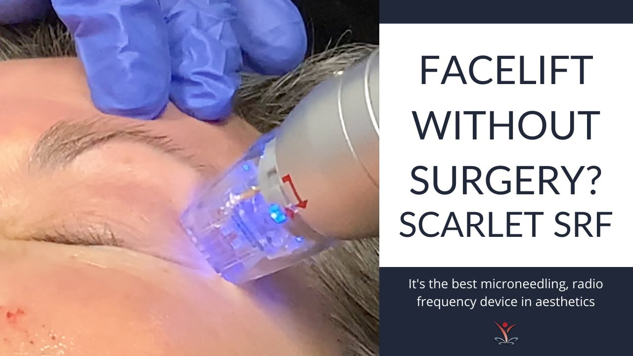 Get Treated Year-Round. Scarlet SRF Works on ALL Skin Types