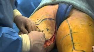 Dr  Hunstad Vertical Thigh Lift