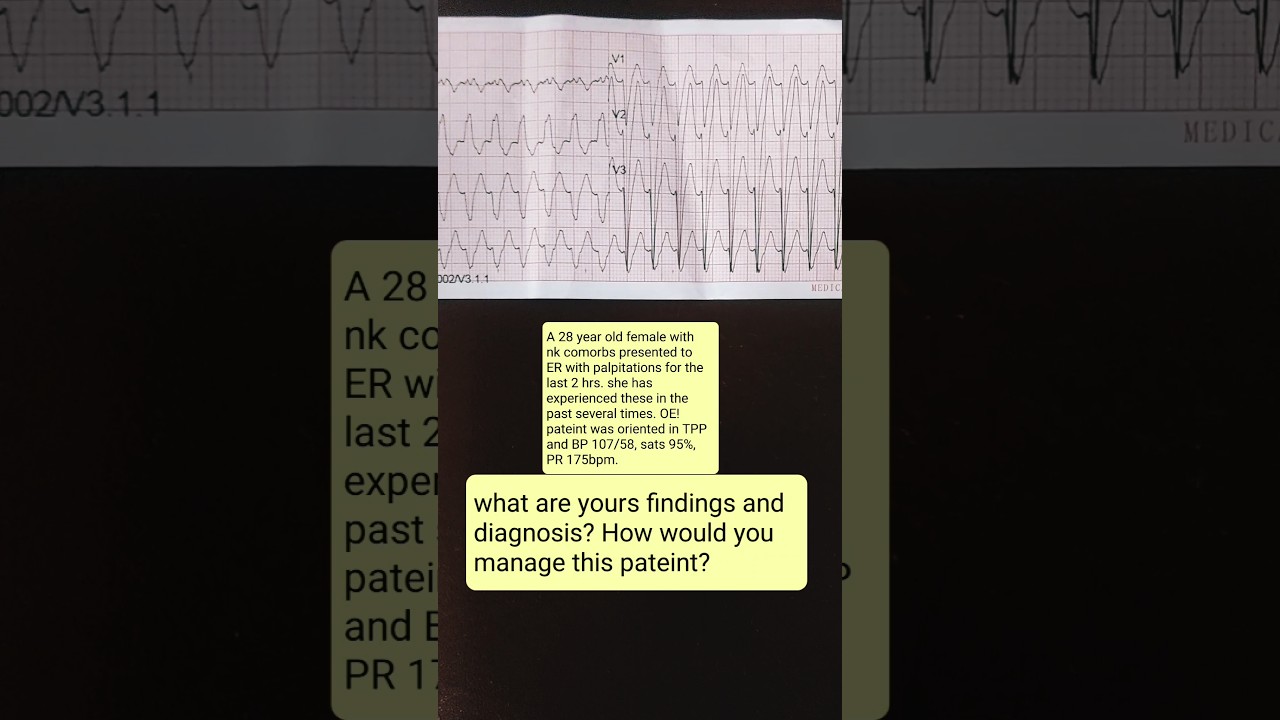 ECG quiz 22! palpitations? What is your diagnosis? #medical