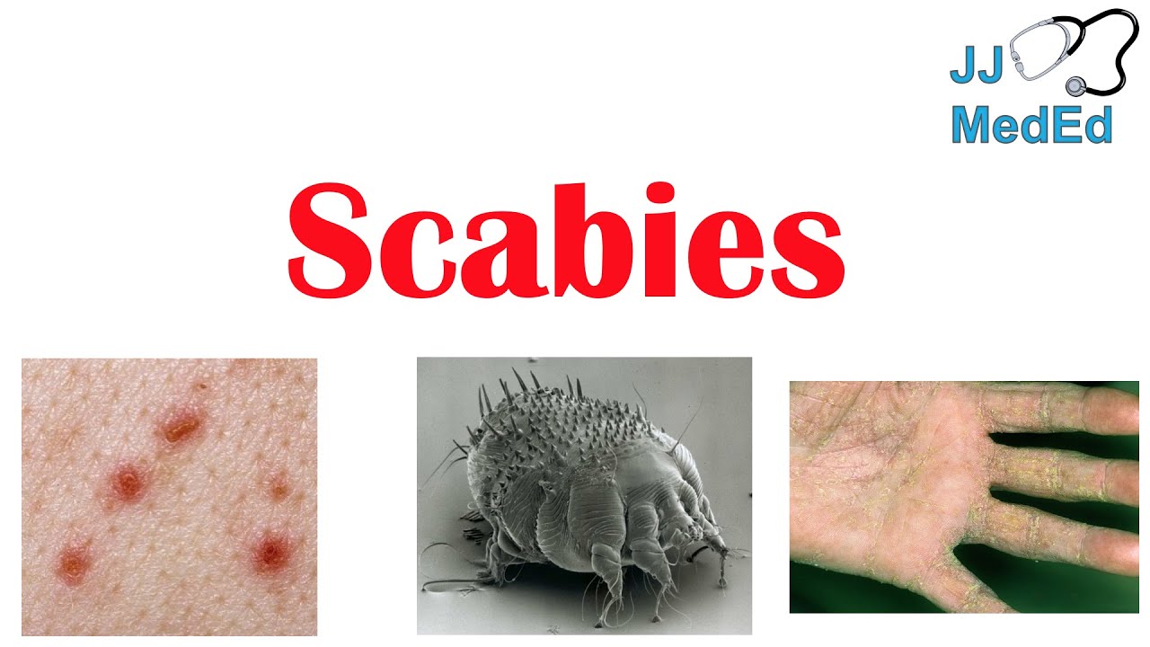 Scabies (Skin Condition)  What Is It, Classic vs. Crusted Types, Signs &  Symptoms, Treatment 