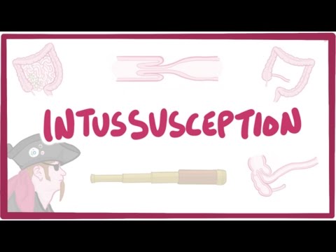 Intussusception - causes, symptoms, diagnosis, treatment, pathology