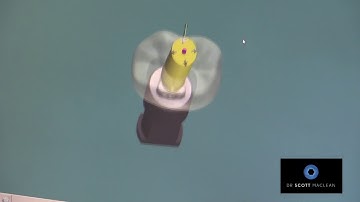 3Shape Lab scanner - ASC Angulated Screw Channel