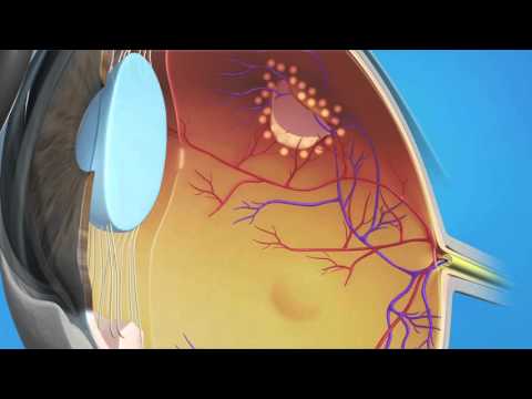Retinal Tear Laser