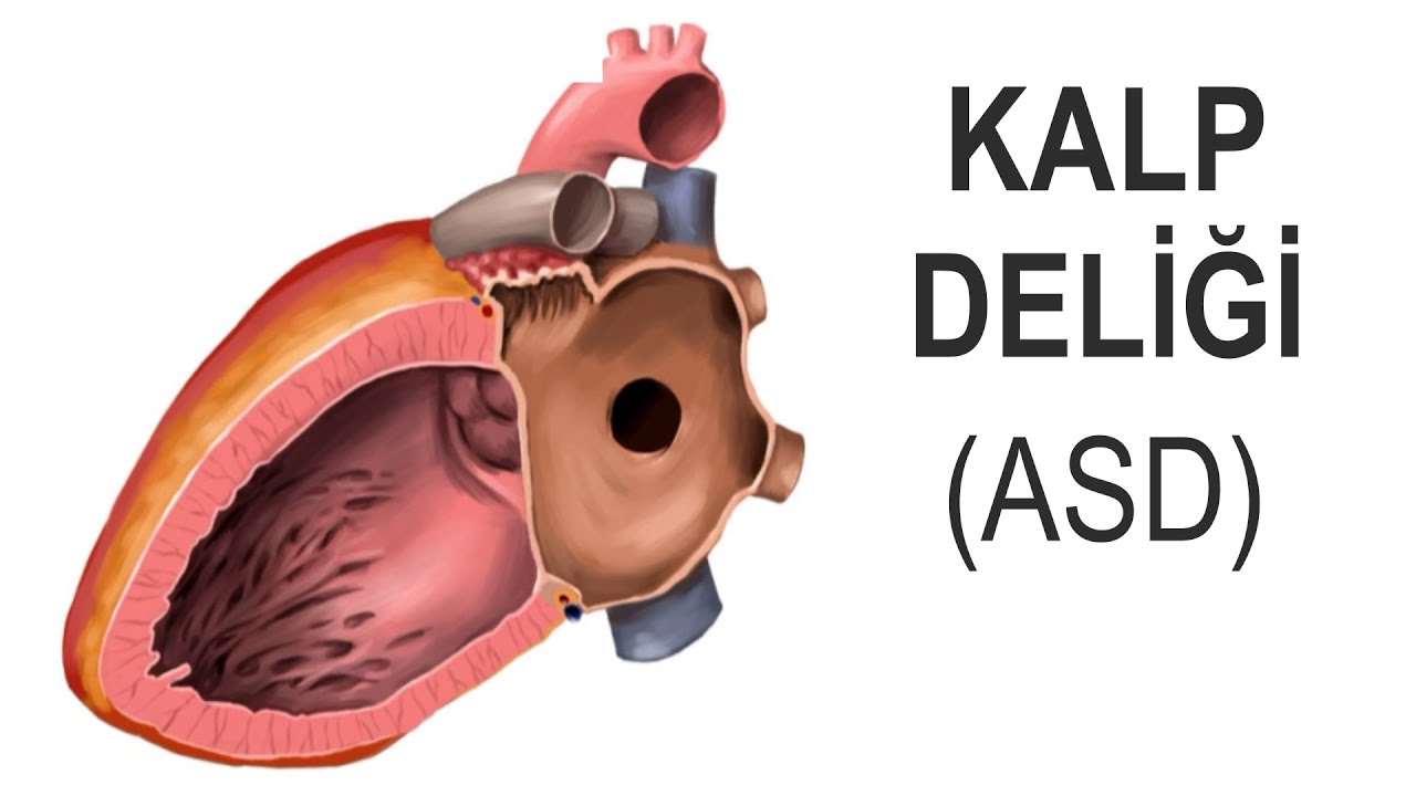 ASD Closure