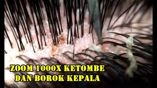 Zoom 1000x ketombe dan borok kepala - jijik banget