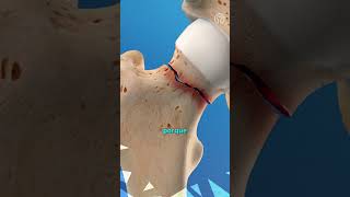 Hip fracture