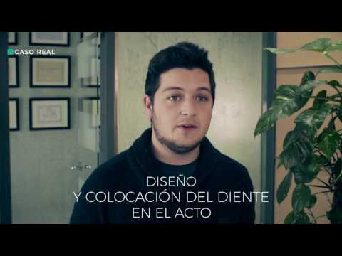 Implantes dentales en Sevilla - Caso real de un implante en Séptima Dental