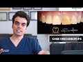 Case discussion 6  composite veneer for discolored tooth