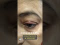 Stye Or Chalazion ( Consult Today ) | Dr. Kartik Gupta | Appointment -8920090907