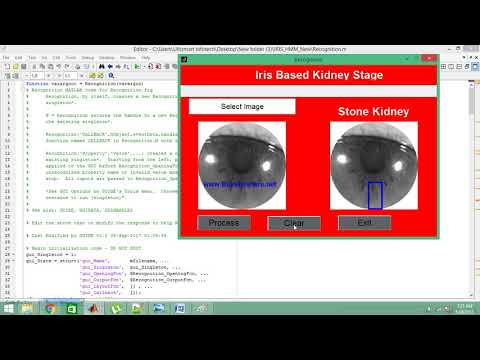 IRIS Based Kidney Decease Detection