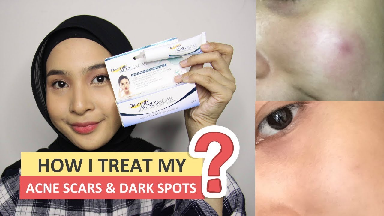  REVIEW & GIVEAWAY  DERMATIX ACNE SCAR GEL - YouTube