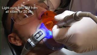 28 VOCO Bifix QM   the easy clean up resin cement in a clinical application