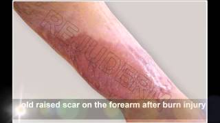 REJUDERM Scar care cream Old raised scar on the forearm after burn injury