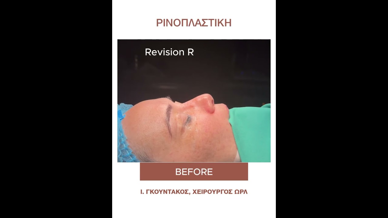Ρινοπλαστική Πριν και Μετά (case 101)