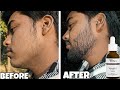 Minoxidil Ne Meri Beard Barbaad Kar Di… Kyun ? minoxidil beard growth mistake | minoxidil beard 2026