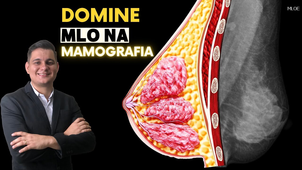 Dominando a incidência MLO na Mamografia