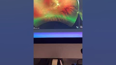 11 year followup keratoconus treated with Athens Protocol CXL: Kanellopoulos, MD