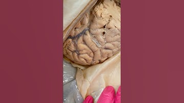 Brain Bleeds! Epidural & Subdural Hematomas