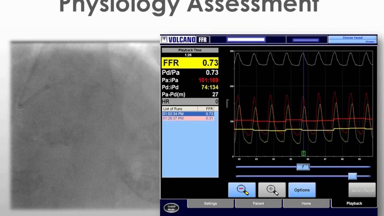 Discordant Angiogram and Noninvasive Stress Test: Can Pressure Wire Help?