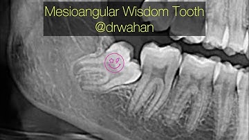 Mesioangular Wisdom Tooth Extraction Step-by-Step @drwahan