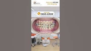 Hành trình LỘT XÁC nhờ niềng răng của Khánh Nghi