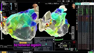 PVI and substrate modification in persistent AF using HD Grid and omnipolar technology