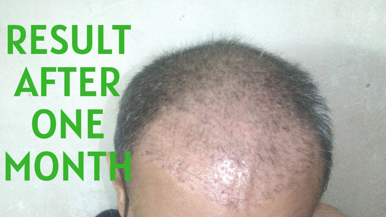 Hair Transplant Result after 1 Month HD 720p YouTube
