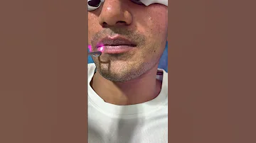 Amazing Q Switch Laser Treatment For Dark Lips Skinaa Clinic Viral Ytshorts Shortsfeed 