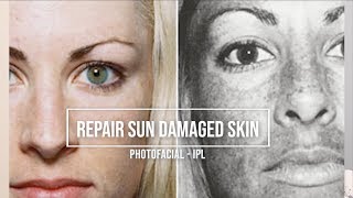 What Is Sun Damage? How Can We Repair It With An Ipl?