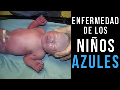 Vídeo: Síndrome Del Bebé Azul: Causas, Síntomas Y Más