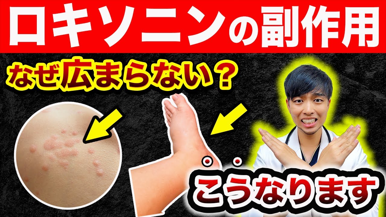 【なぜ知られない?】ロキソニンを毎日飲むと『体が変化』します。【危険】現役医師解説｜湿布や市販薬のオススメは？