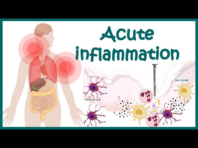 Inflammatory Mediators In The Pathogenesis Of The Role Of Inflammatory