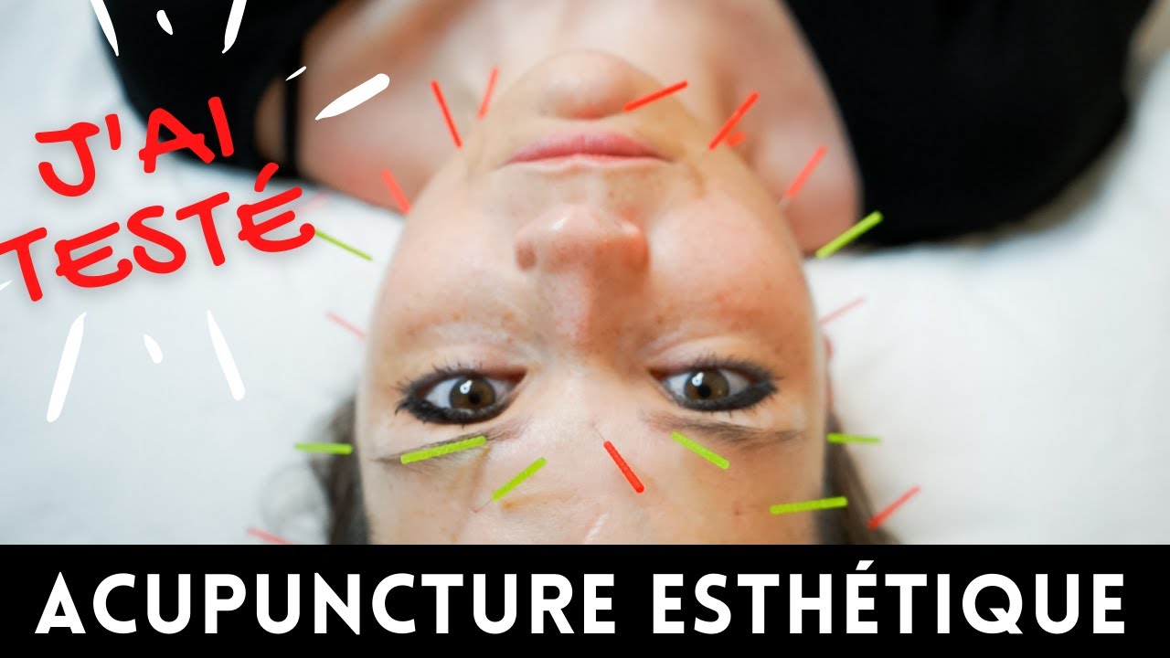 J'AI TESTÉ l'acupuncture esthétique AKA lifting par acupuncture