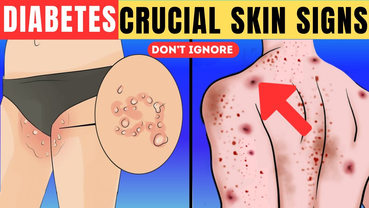 13 Crucial Skin Signs of Diabetes