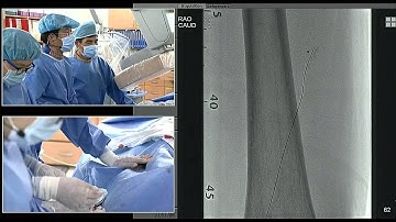 TCTAP 2015 Endovascular Live Case Session I. Complex Cases Intervention: SFA