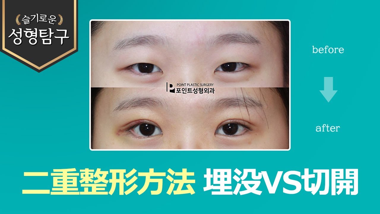 【韓国二重整形】埋没と切開で悩むなら