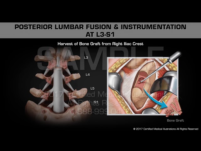 Posterior Lumbar Fusion u0026 Instrumentation at L3-S1 class=