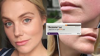 Aczone Dapsone Gel 5% Review Chronic Adult Acne 2 Month Progress 2021