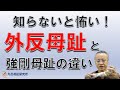 知らないと怖い！外反母趾と強剛母趾の違い：外反母趾研究所