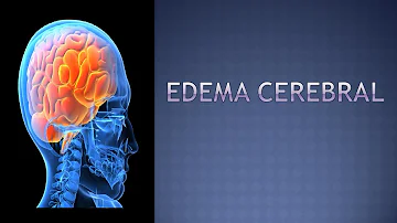 ¿Cuáles son los síntomas del edema cerebral?