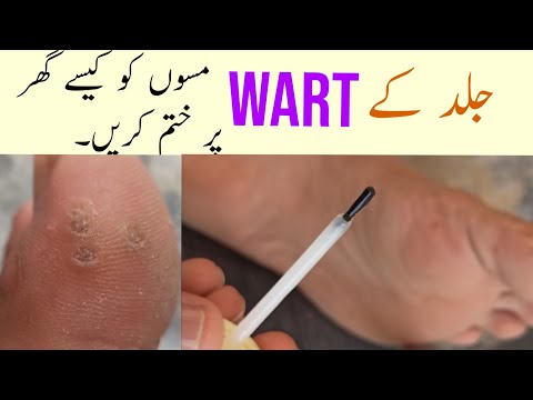 Comment traiter WART à la maison Urdu / Hindi