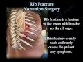 Rib Fracture Nonunion Surgery - Everything You Need To Know - Dr. Nabil Ebraheim