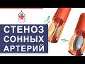 1. 💤 Уникальный метод лечения атеросклероза сонных артерий. Лечение атеросклероза сонных артерий.12+