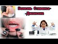 синдром стивенса джонсана, болезнь Стивенса-Джонсона,