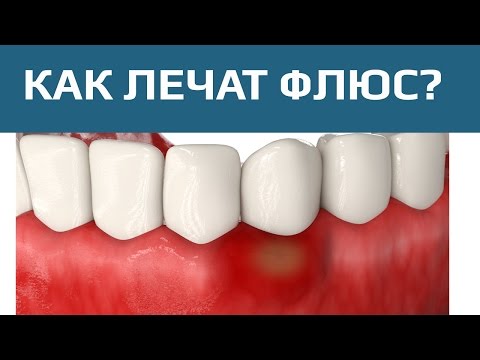 Лечение зубов. Лечение флюса с сохранением зуба