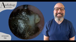 CHUNKY EAR WAX PLUGS & HARD SKIN REMOVAL FROM EAR - EP785