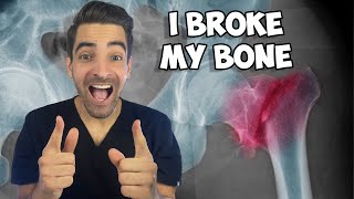 I Broke My Bone