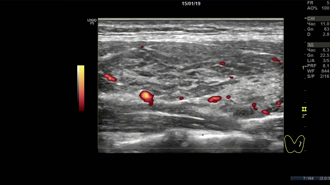 Клинический случай 5. (УЗИ Щитовидной Железы ) доктор А.В. Ушаков