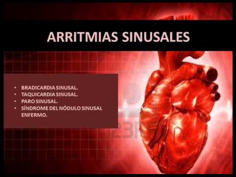 Video: ¿La arritmia del ritmo sinusal?